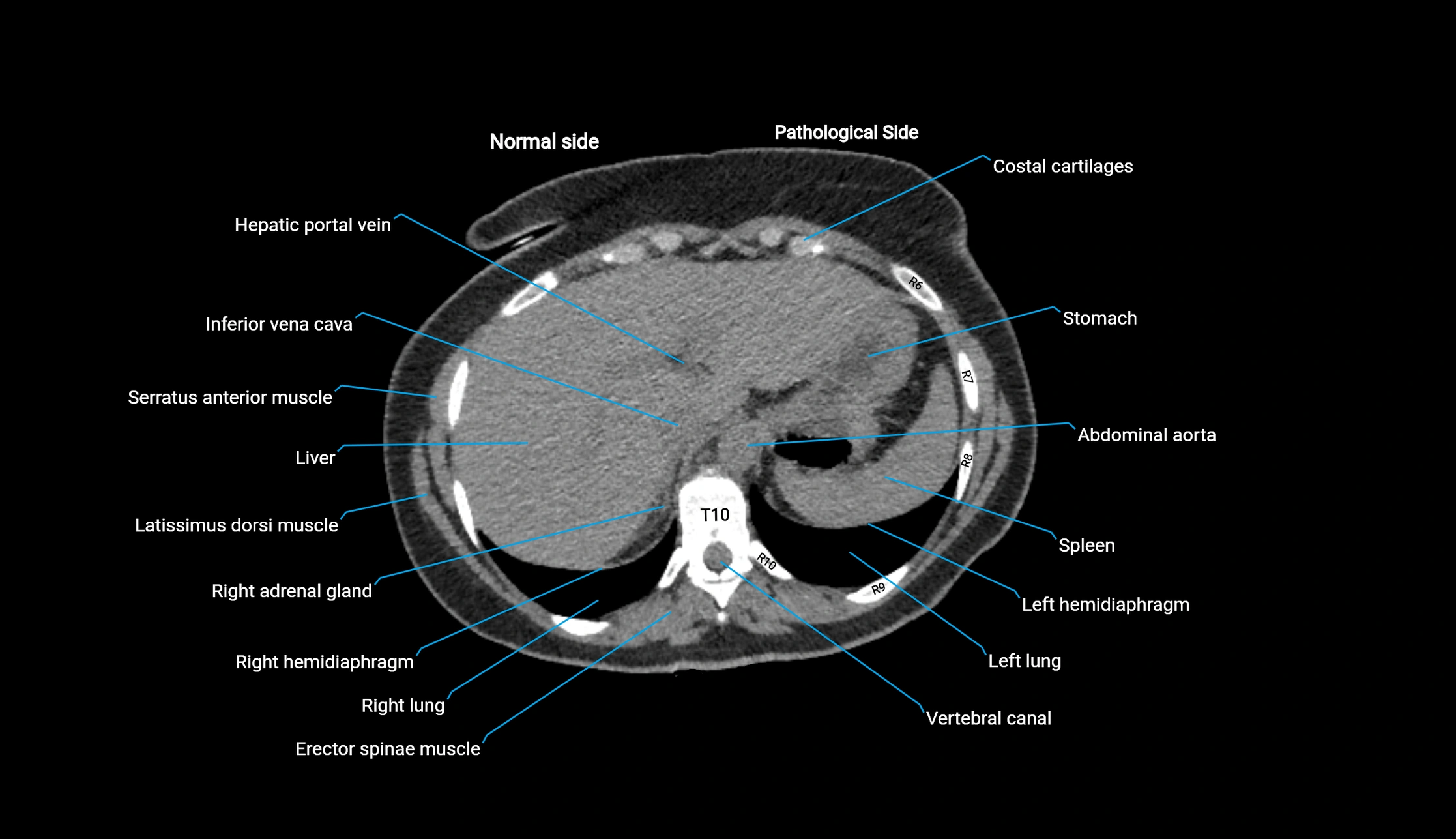 CT KUB axial cross sectional anatomy  radiology image -img-00201-00008.webp